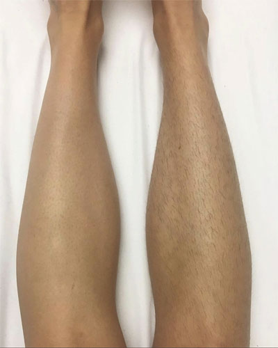 Epilare Definitivă Laser 16 epilare laser