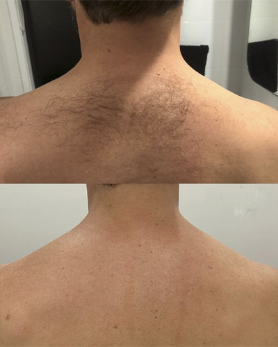 Epilare Definitivă Laser 17 epilare laser1