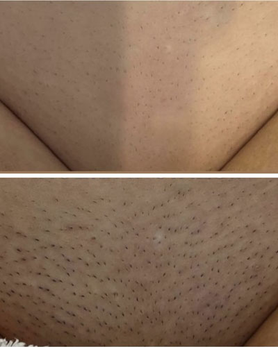 Epilare Definitivă Laser 18 epilare laser3