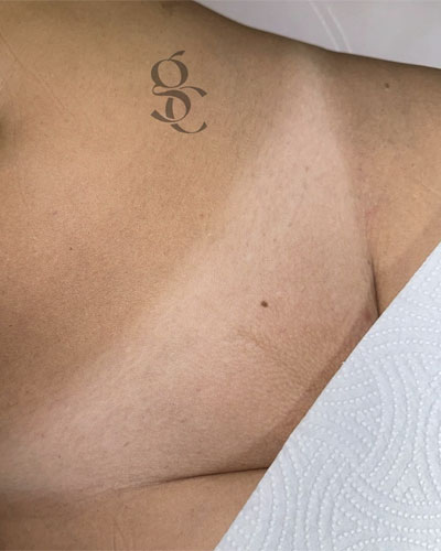 Epilare Definitivă Laser 19 epilare laser4