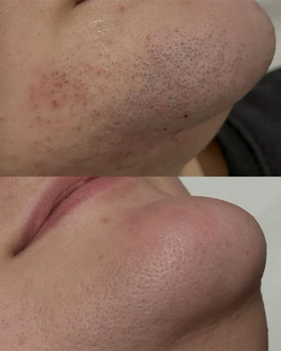 Epilare Definitivă Laser 20 epilare laser6
