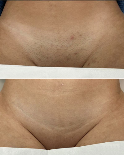 Epilare Definitivă Laser 21 epilare laser7