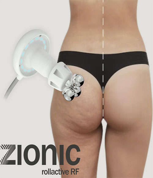 Tratament Zionic 28 tratament zionic6