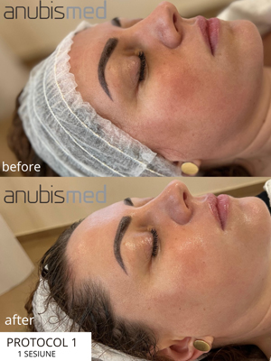 tratamente faciale18